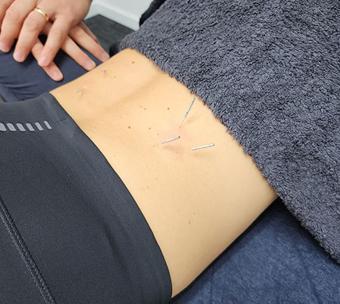 dry needling physio